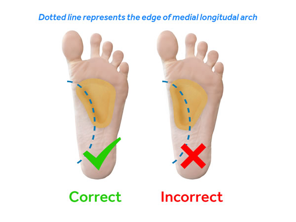 metatarsal-pad-longitudal-arch