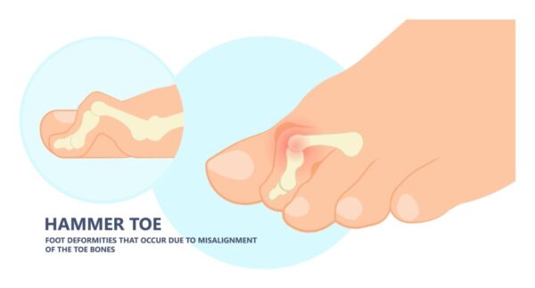 Shoes for Hammer Toes: Are High Heels Deforming Your Feet?