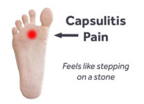 Do You Have Pain in the Ball of Your Foot? How to Diagnose and Treat Capsulitis
