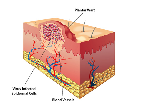 what kills a wart virus