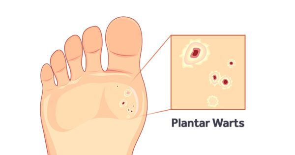 Treatment and Removal of Plantar Warts - Kids' Foot Health