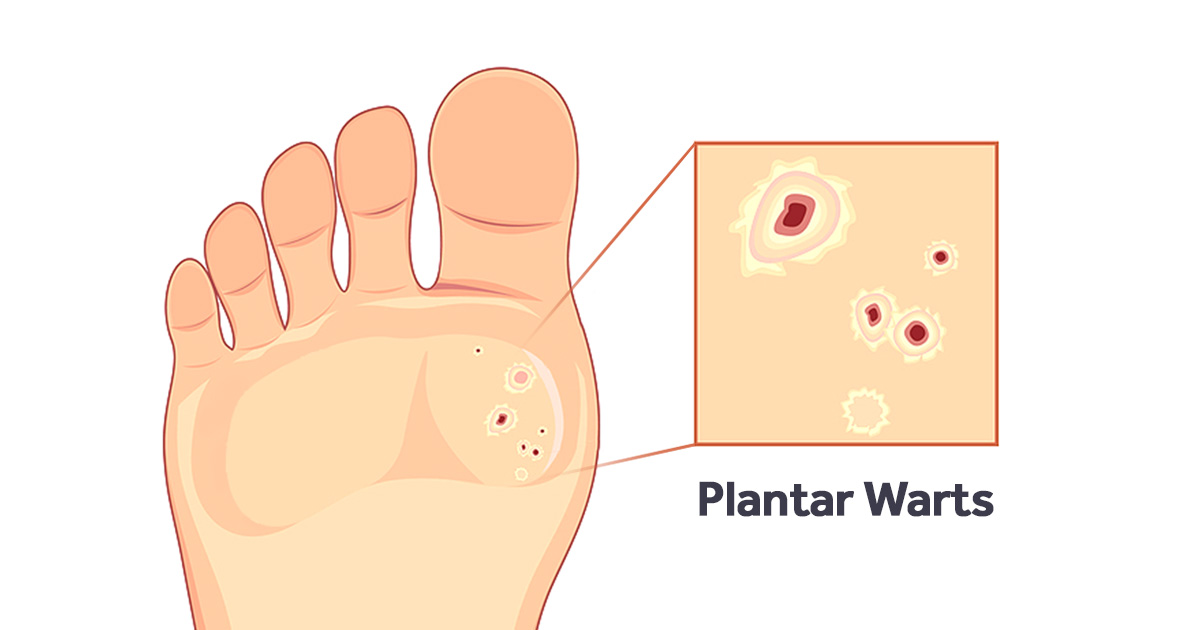 wart on foot or blister