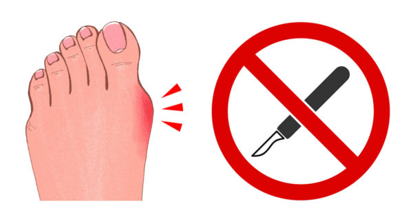 Treating Bunions Without Surgery: Easier Than You Think