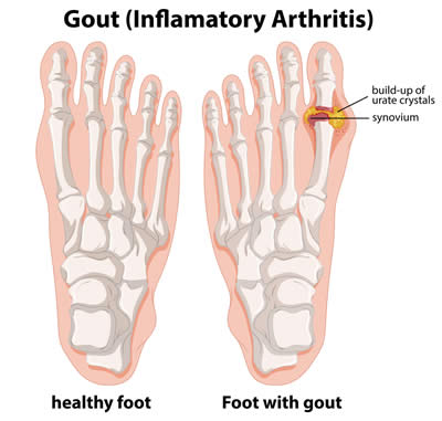 gout-inflammation