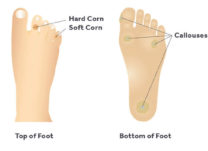 What Causes Foot Calluses and Corns? Tips for Prevention and Treatment