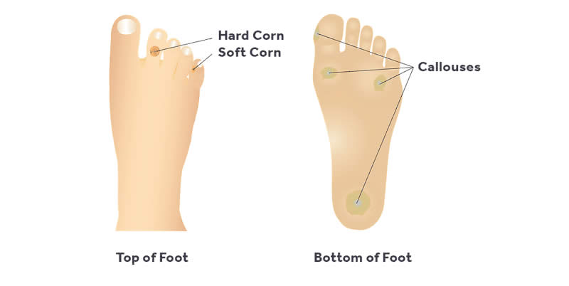 toe callus treatment