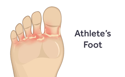 Athlete s Foot vs Shoe Contact Dermatitis Softstar Blog