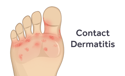 Athlete S Foot Vs Contact Dermatitis Softstar Blog Athlete S Foot Vs Contact Dermatitis Softstar Blog