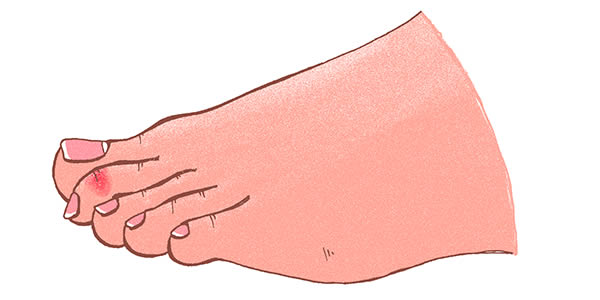 Drawing of Hammer Toes