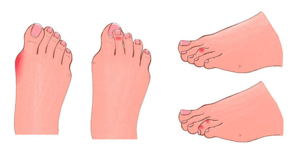 Bent, Crooked Toes: Tips for Treatment and Prevention