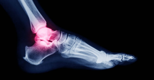 How to Strengthen Ankles and Test if You Have Strong Ankles