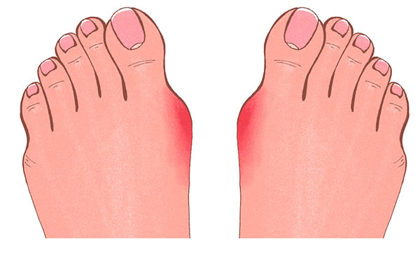 Bunions