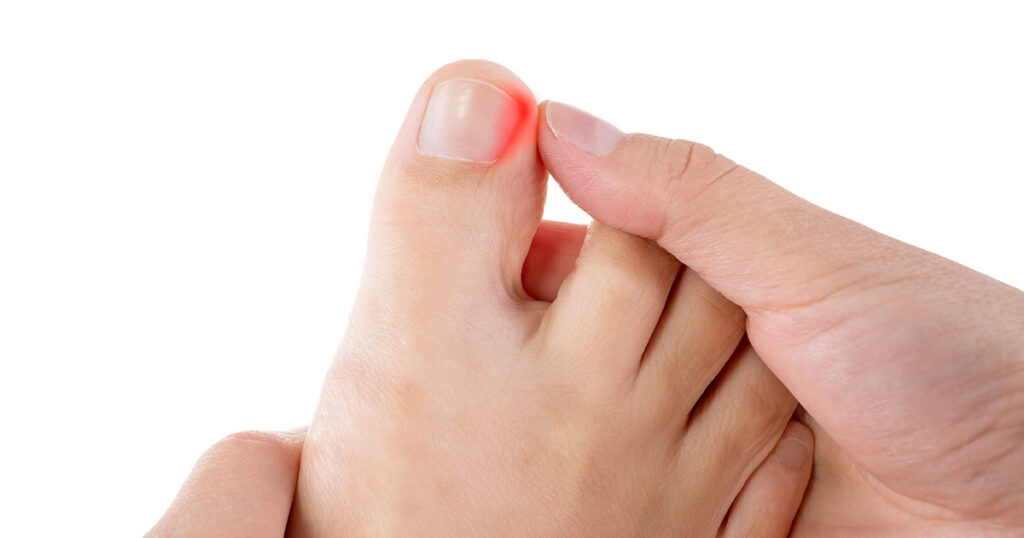 What Causes Ingrown Toenails? Tips for Prevention and Treatment